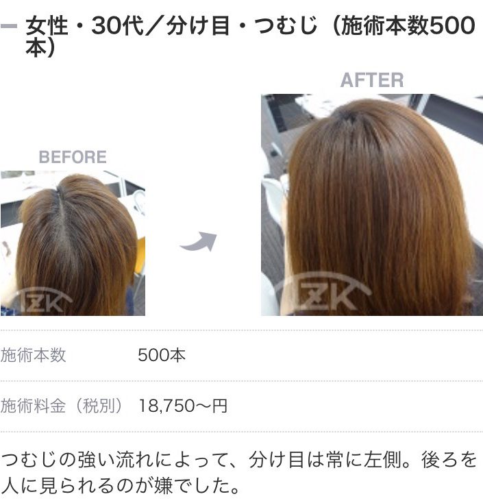 女性型の脱毛症のお悩みも多いですよね 福島県郡山市の 大人のヘアデザイン 髪質改善 増毛ボリュームエクステ 特化美容室 プールブー オリジン ｐｏｕｒｖｏｕｓ Origin